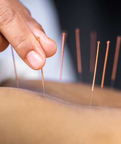Acupuncture-Needle-Being-Placed.jpg