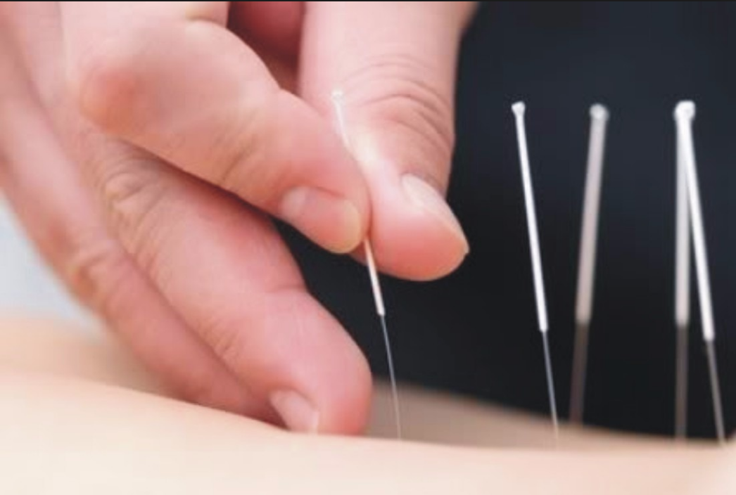 Acupuncture for Aches and Pains
