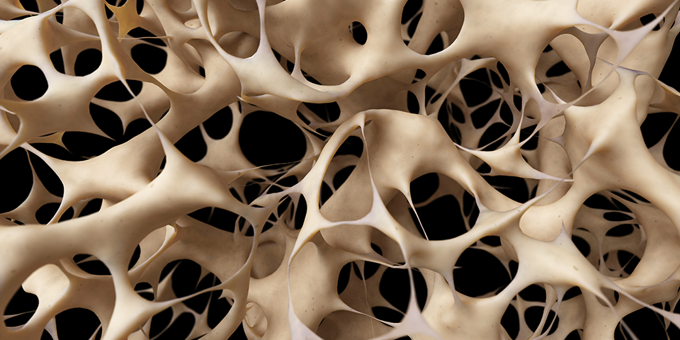 Osteoporosis: Risk Factors and Symptoms